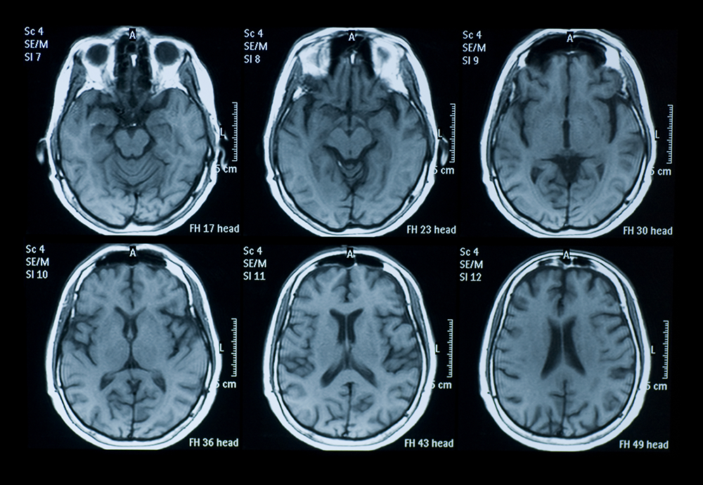 Another Promising Treatment for Alzheimers disease